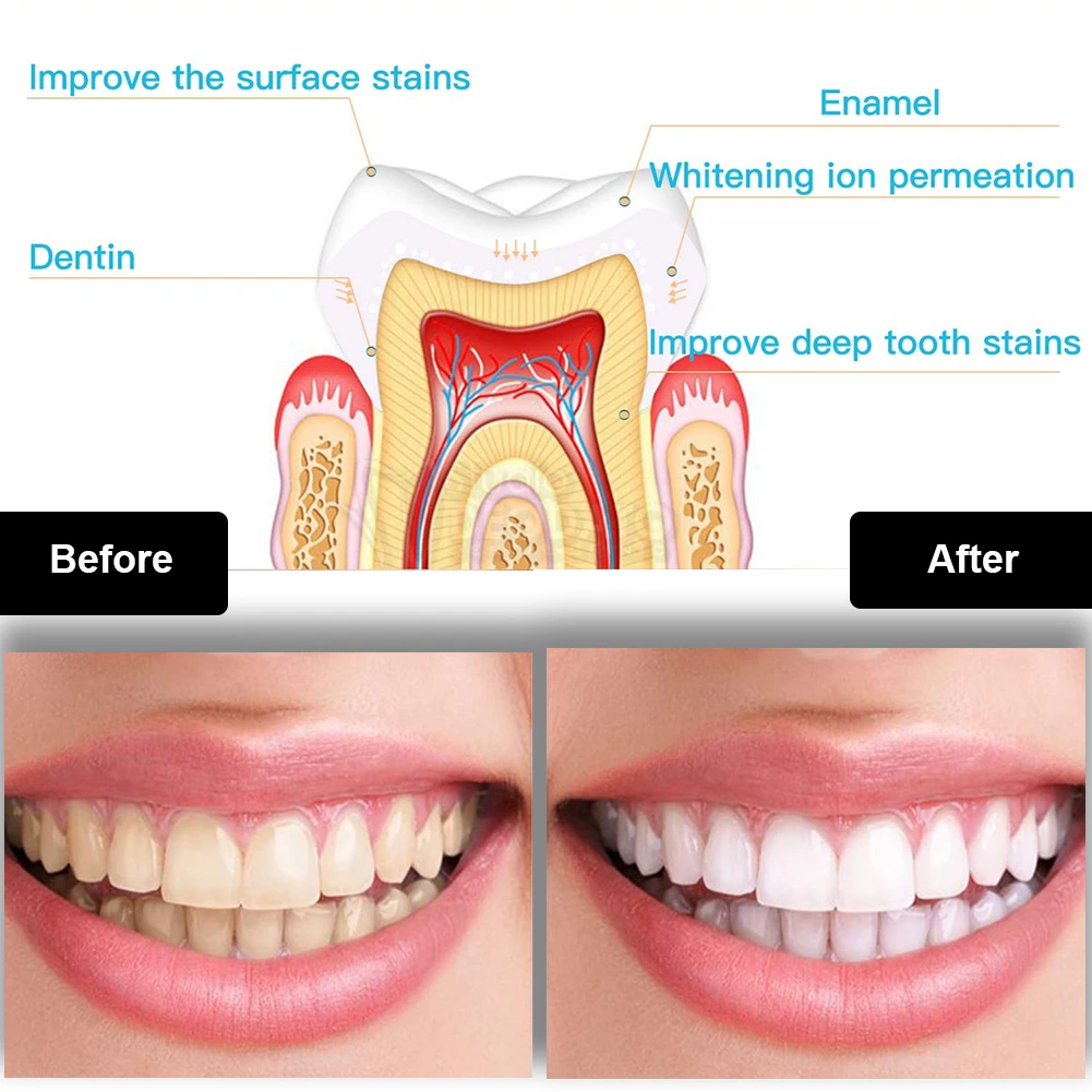 Dental Teeth Whitening Kit Min - Teeth Whitening Levels recension och pris