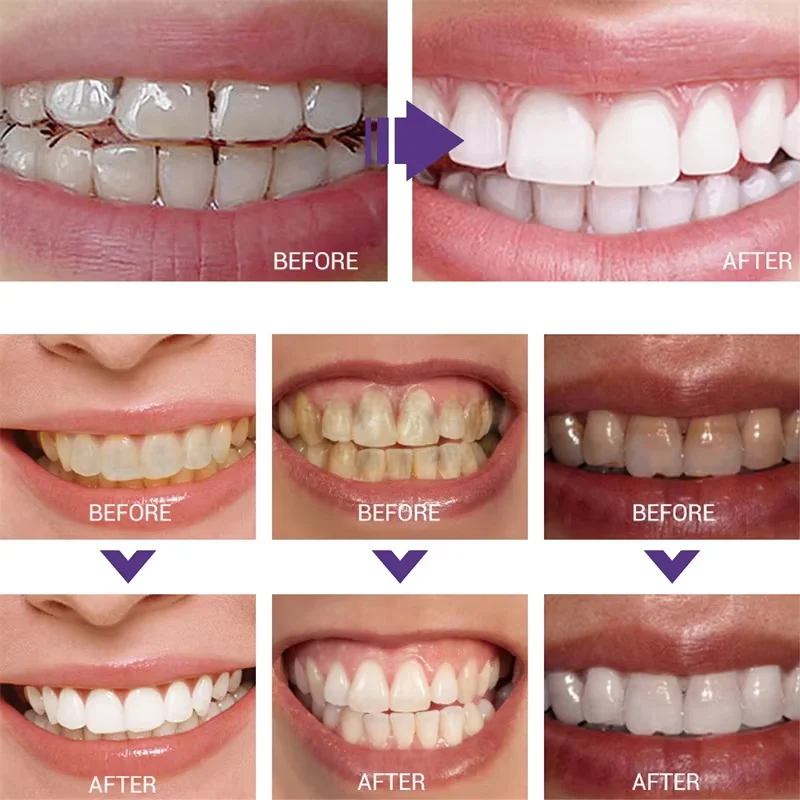 Whitening Toothpaste Teeth Cle - Teeth Whitening In Korea recension och pris